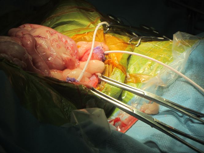 close up view of SUB cystostomy and neprhrostomy tubes during placement